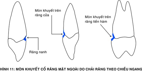 lam-gi-khi-chai-rang-sach-van-bi-sau-rang-01 lam-gi-khi-chai-rang-sach-van-bi-sau-rang-01