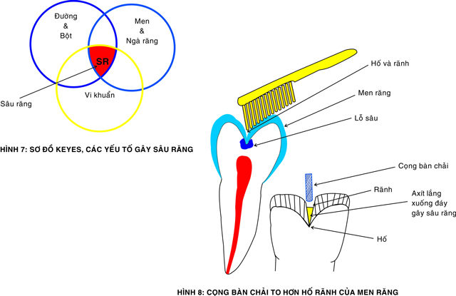 nguyen-nhan-gay-sau-rang-01-1 nguyen-nhan-gay-sau-rang-01