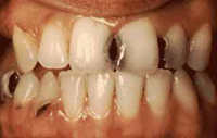 sau-rang-lam-sao-1