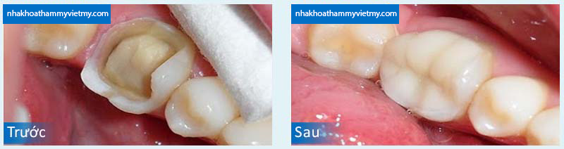 Trám Răng Nha Khoa Thẩm Mỹ Việt Mỹ